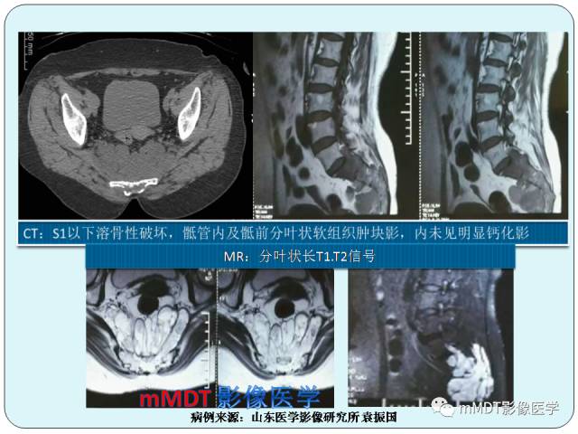 【PPT】骶尾骨脊索瘤的影像诊断