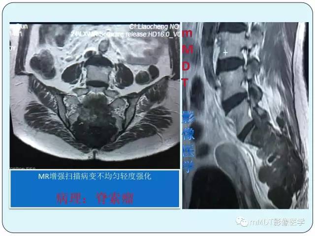 【PPT】骶尾骨脊索瘤的影像诊断