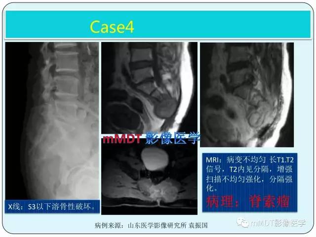 【PPT】骶尾骨脊索瘤的影像诊断