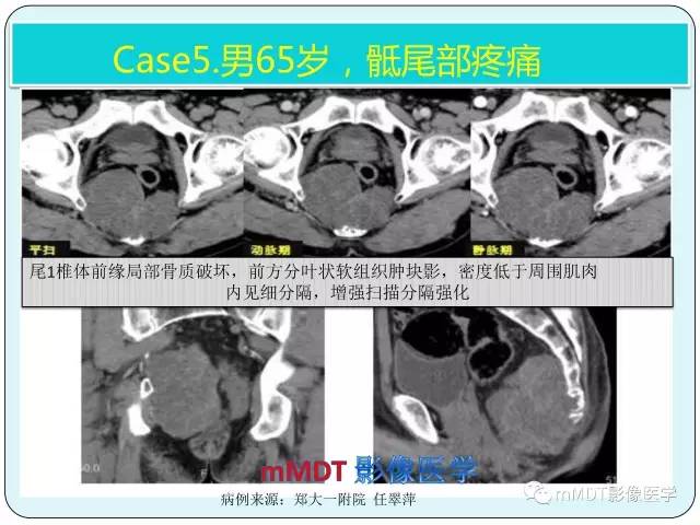 【PPT】骶尾骨脊索瘤的影像诊断