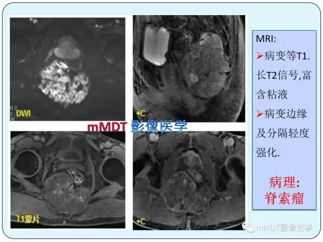 【PPT】骶尾骨脊索瘤的影像诊断