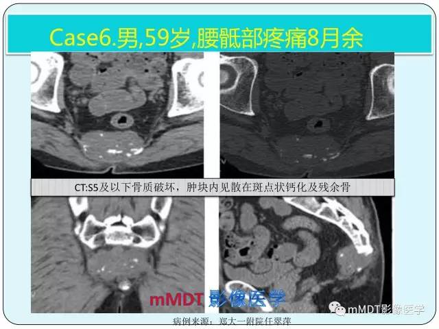 【PPT】骶尾骨脊索瘤的影像诊断