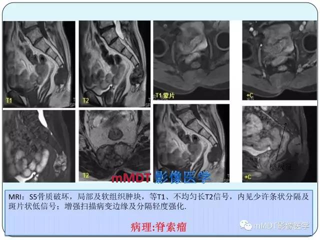 【PPT】骶尾骨脊索瘤的影像诊断