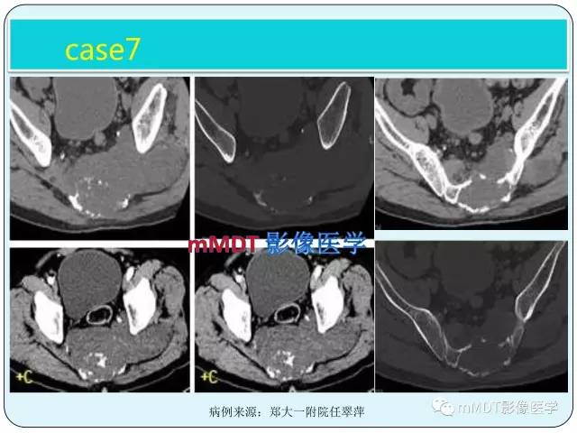【PPT】骶尾骨脊索瘤的影像诊断