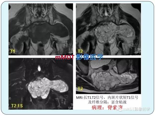 【PPT】骶尾骨脊索瘤的影像诊断