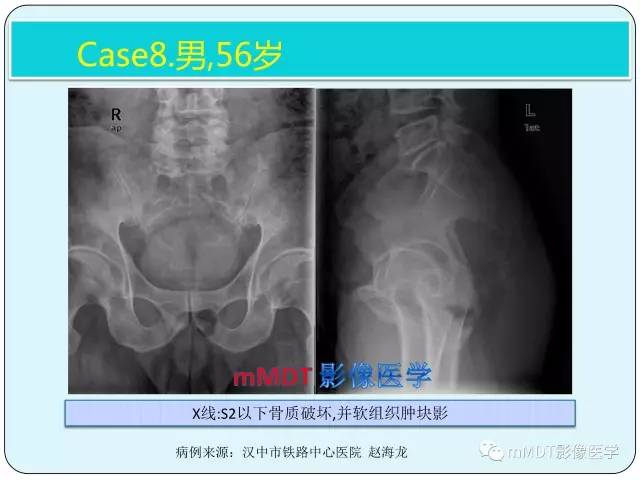 【PPT】骶尾骨脊索瘤的影像诊断