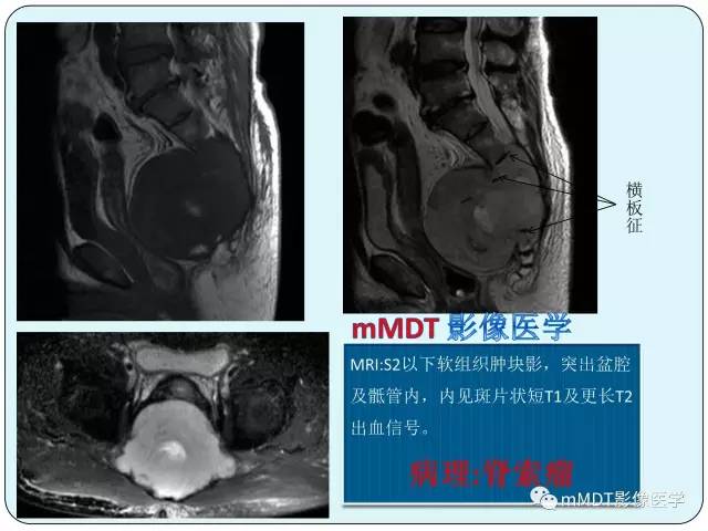 【PPT】骶尾骨脊索瘤的影像诊断
