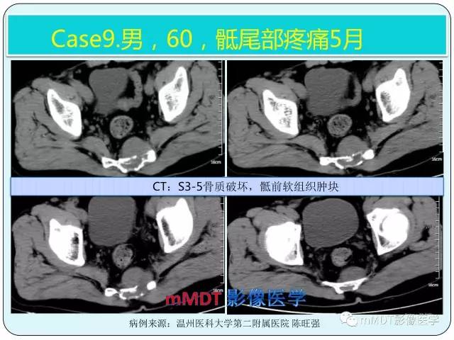 【PPT】骶尾骨脊索瘤的影像诊断