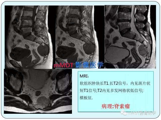 【PPT】骶尾骨脊索瘤的影像诊断