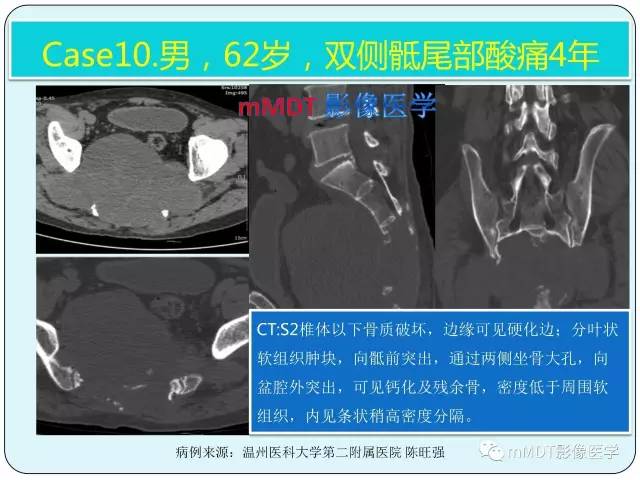 【PPT】骶尾骨脊索瘤的影像诊断