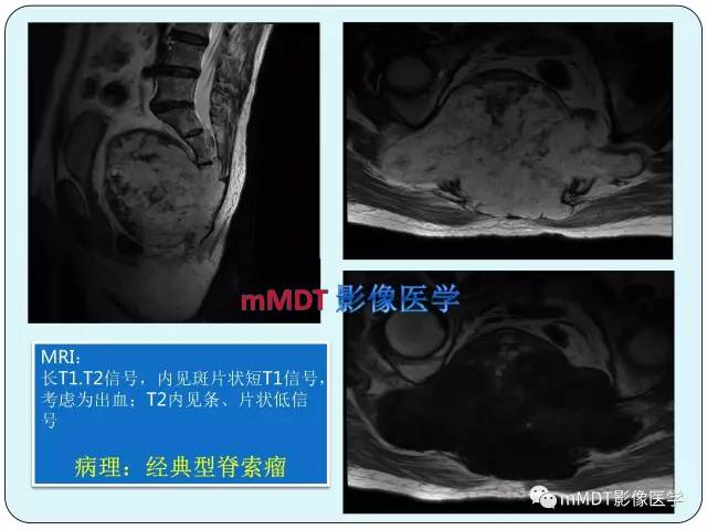 【PPT】骶尾骨脊索瘤的影像诊断