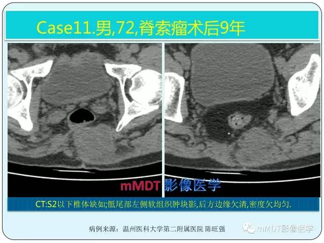 【PPT】骶尾骨脊索瘤的影像诊断