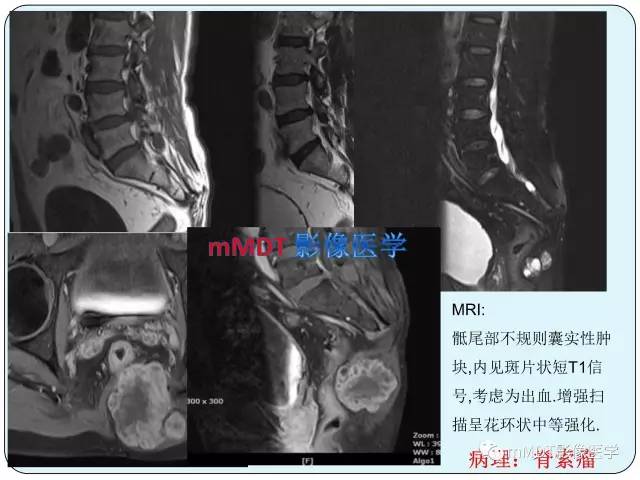 【PPT】骶尾骨脊索瘤的影像诊断