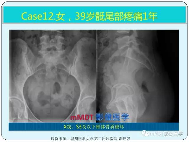 【PPT】骶尾骨脊索瘤的影像诊断