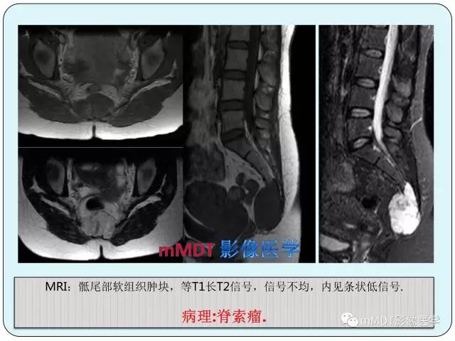 【PPT】骶尾骨脊索瘤的影像诊断