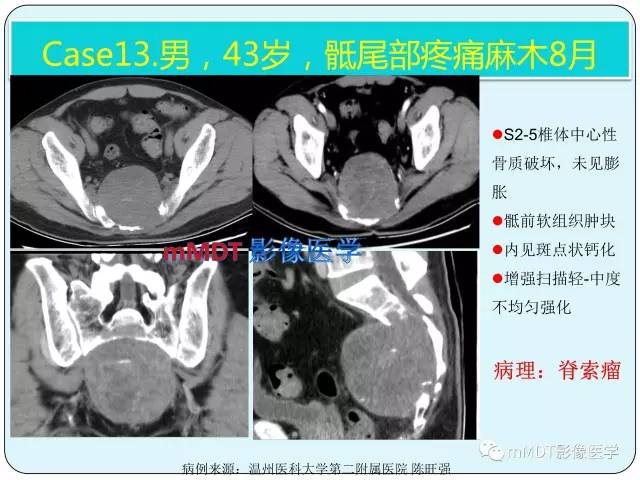 【PPT】骶尾骨脊索瘤的影像诊断