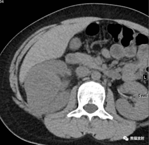 【病例】肾母细胞瘤1例CT