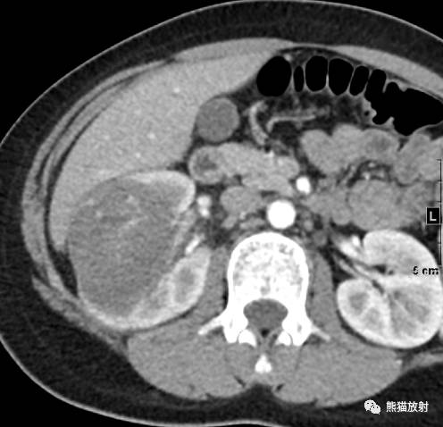 【病例】肾母细胞瘤1例CT 【病例】肾母细胞瘤1例CT