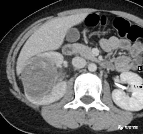 【病例】肾母细胞瘤1例CT 【病例】肾母细胞瘤1例CT