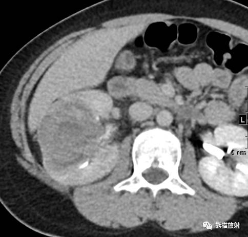 【病例】肾母细胞瘤1例CT 【病例】肾母细胞瘤1例CT