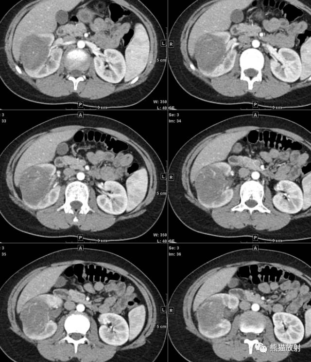 【病例】肾母细胞瘤1例CT 【病例】肾母细胞瘤1例CT