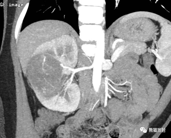 【病例】肾母细胞瘤1例CT 【病例】肾母细胞瘤1例CT