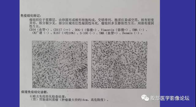 【病例】胃肠道间质瘤1例CT影像表现 【病例】胃肠道间质瘤1例CT影像表现