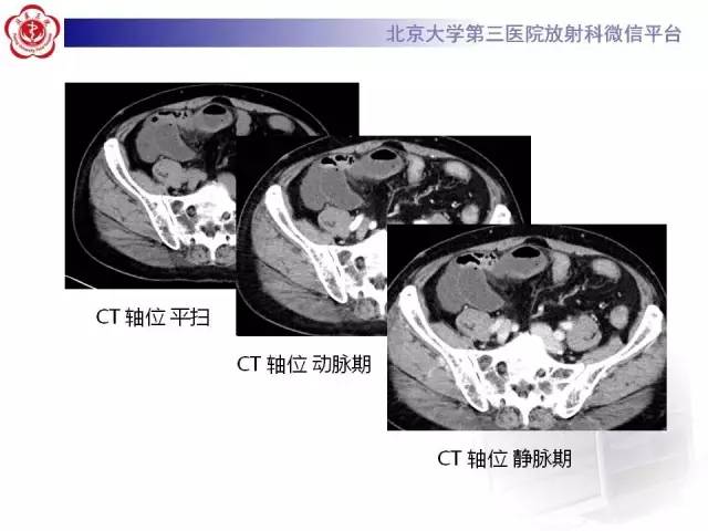 【病例】腹内疝1例CT影像表现