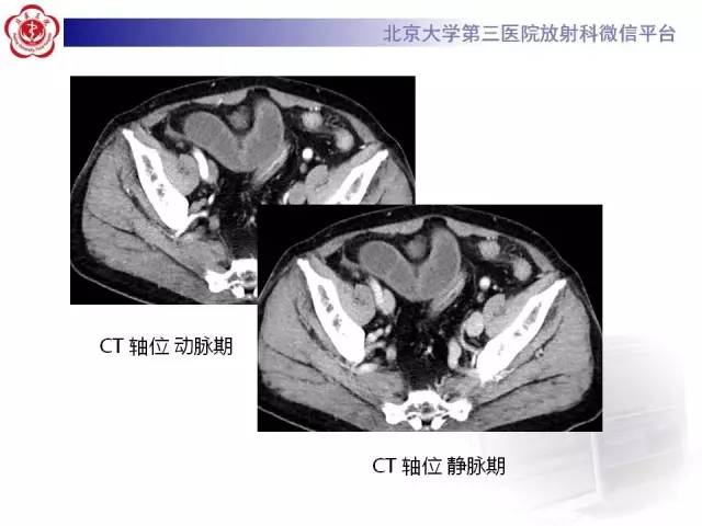 【病例】腹内疝1例CT影像表现
