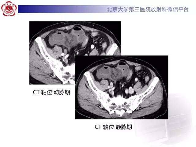 【病例】腹内疝1例CT影像表现