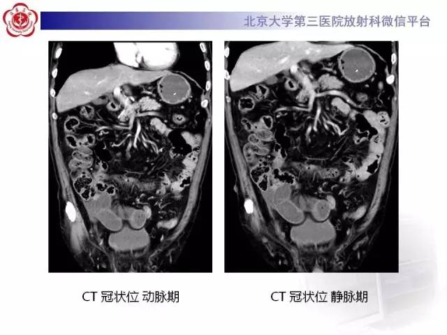【病例】腹内疝1例CT影像表现