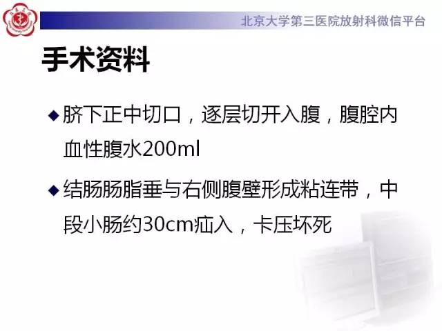 【病例】腹内疝1例CT影像表现