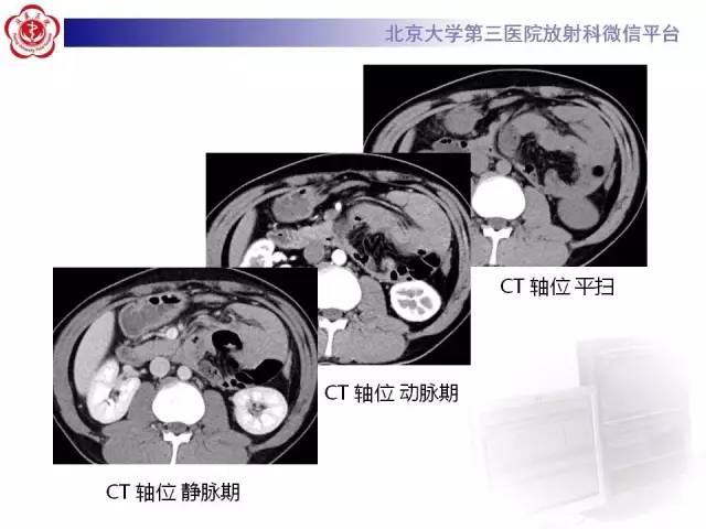 【病例】腹内疝1例CT影像表现