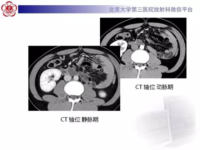 【病例】腹内疝1例CT影像表现