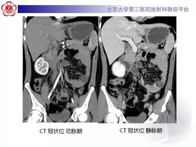 【病例】腹内疝1例CT影像表现