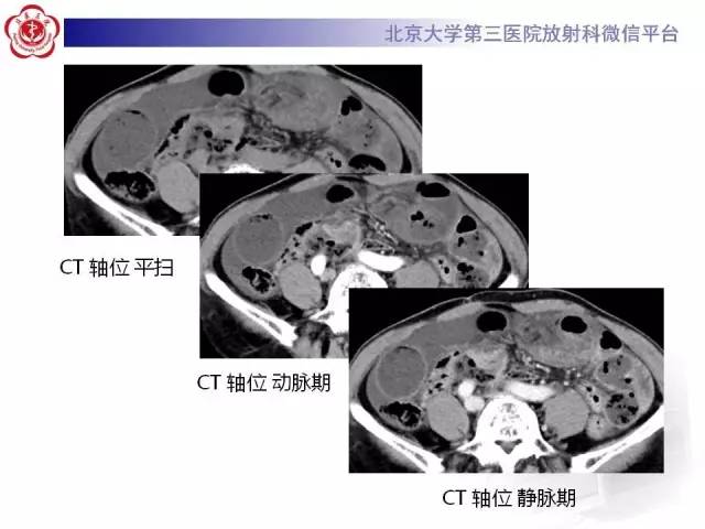 【病例】腹内疝1例CT影像表现