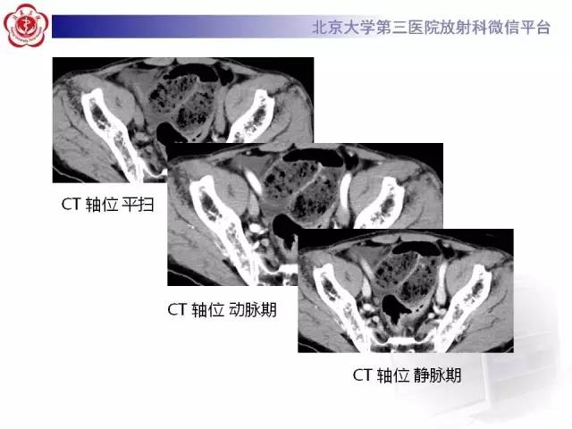 【病例】腹内疝1例CT影像表现