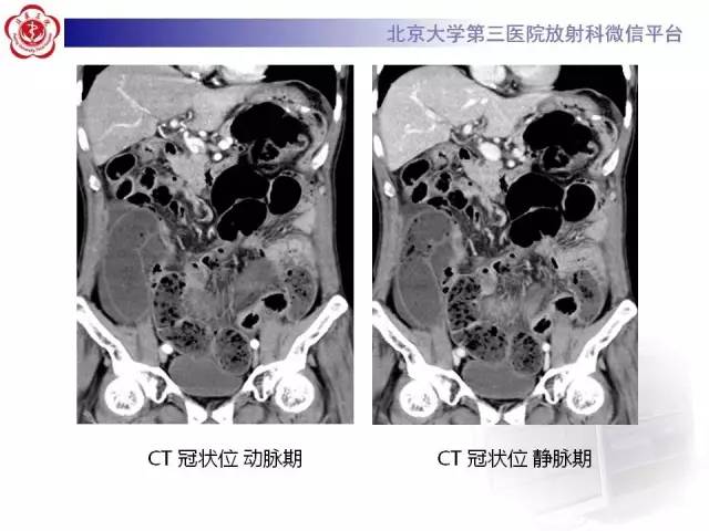 【病例】腹内疝1例CT影像表现