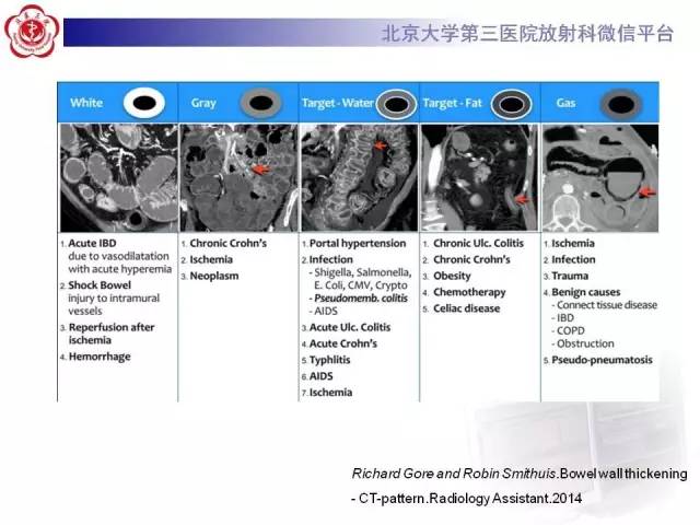 【病例】腹内疝1例CT影像表现