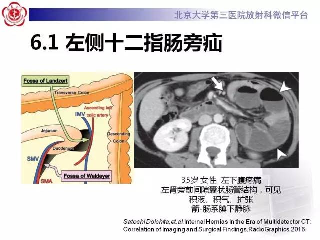 【病例】腹内疝1例CT影像表现