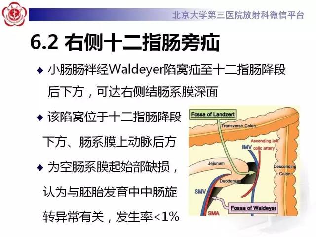 【病例】腹内疝1例CT影像表现