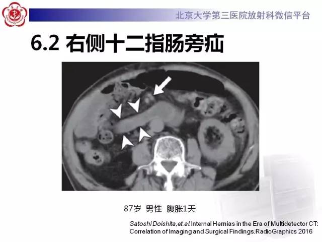 【病例】腹内疝1例CT影像表现