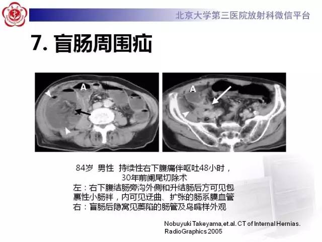 【病例】腹内疝1例CT影像表现