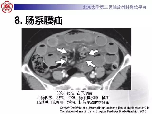 【病例】腹内疝1例CT影像表现