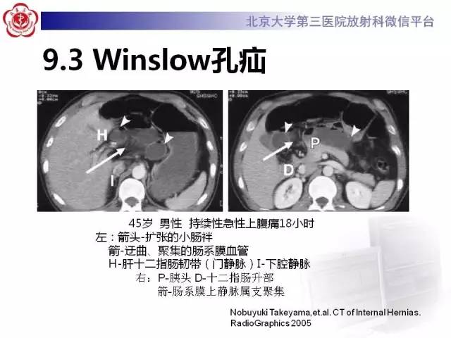 【病例】腹内疝1例CT影像表现