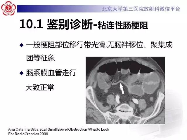 【病例】腹内疝1例CT影像表现
