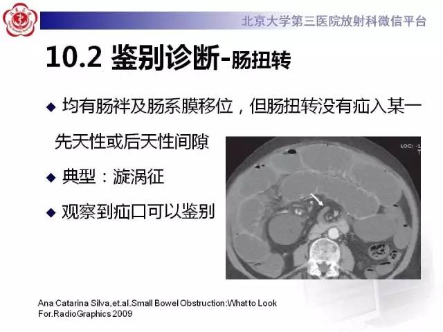 【病例】腹内疝1例CT影像表现
