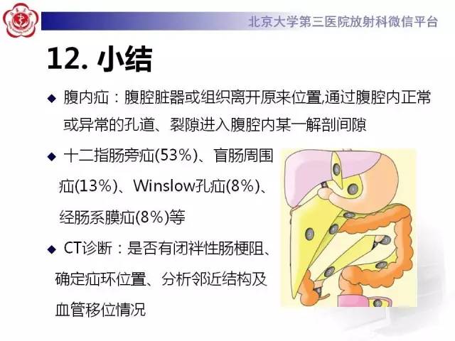 【病例】腹内疝1例CT影像表现