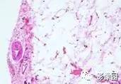 【病例】左侧大腿根部脂肪瘤1例CT影像诊断分析 【病例】左侧大腿根部脂肪瘤1例CT影像诊断分析