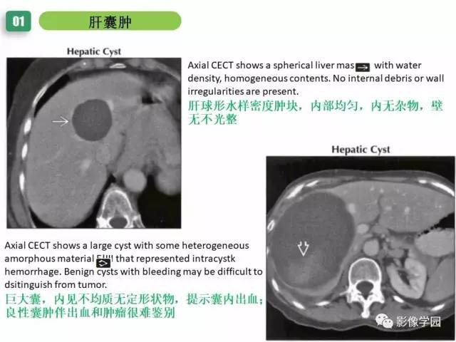 【PPT】疾病谱——肝囊性肿块